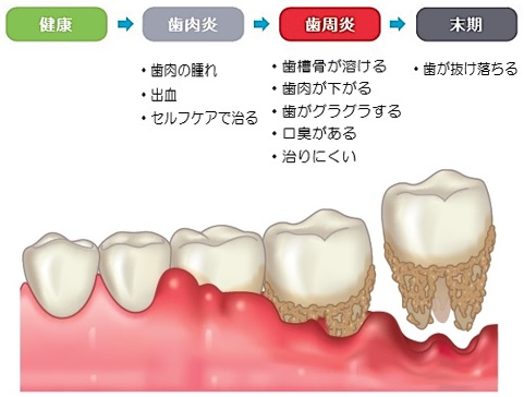 新型コロナに負けない「健康のヒント」Ⅶ～歯周病と全身の健康～ | お知らせ | JFOHP::日本口腔保健協会::