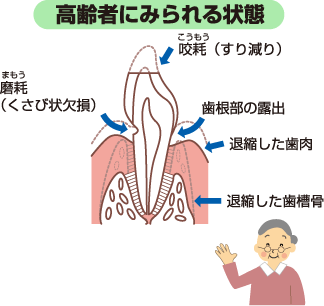 高齢者のお口の健康｜お口の健康情報ナビ｜JFOHP::日本口腔保健協会::